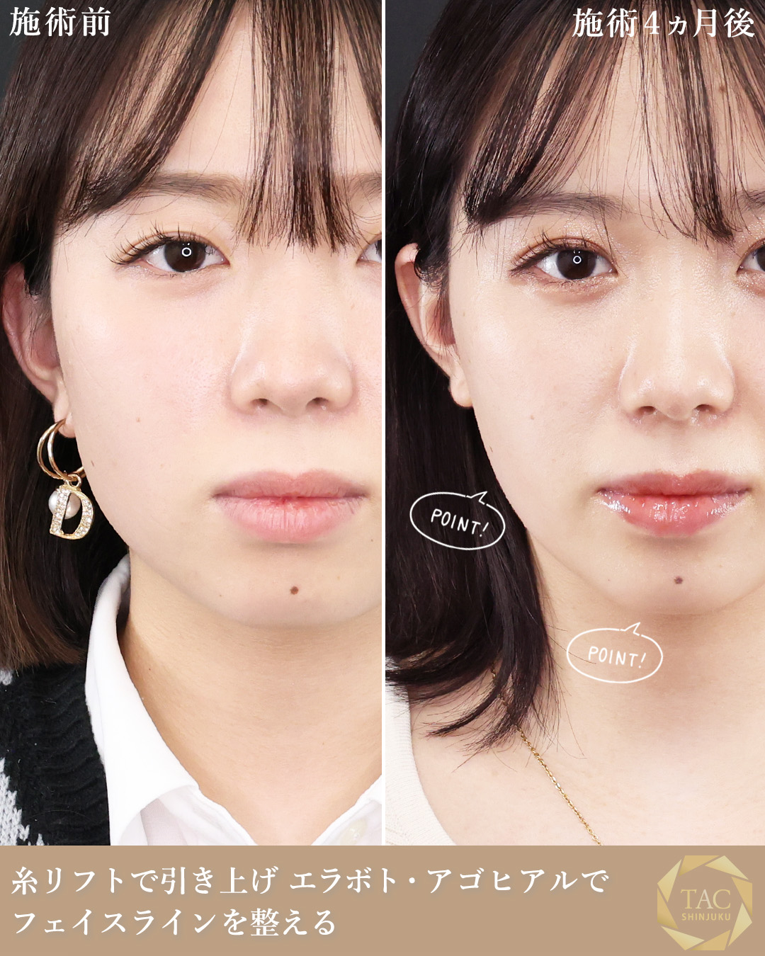 二重埋没法/TAC式 ツヤ肌コラーゲンリフト®/エラボトックス注射の症例写真 施術前後 