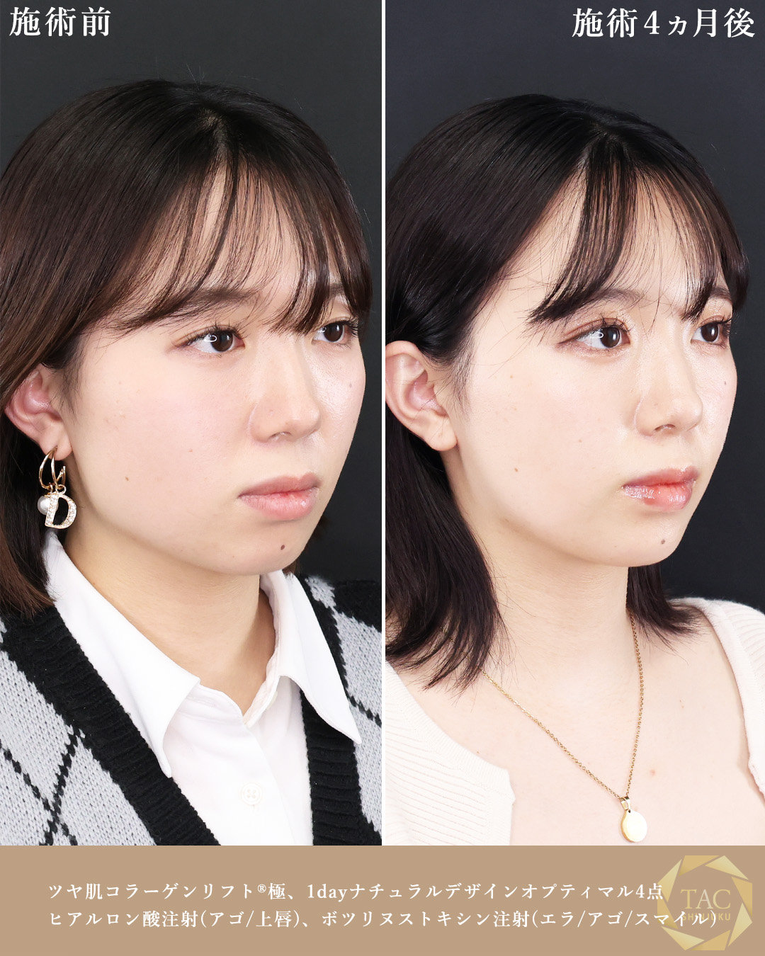 二重埋没法/TAC式 ツヤ肌コラーゲンリフト®/エラボトックス注射の症例写真 施術前後 