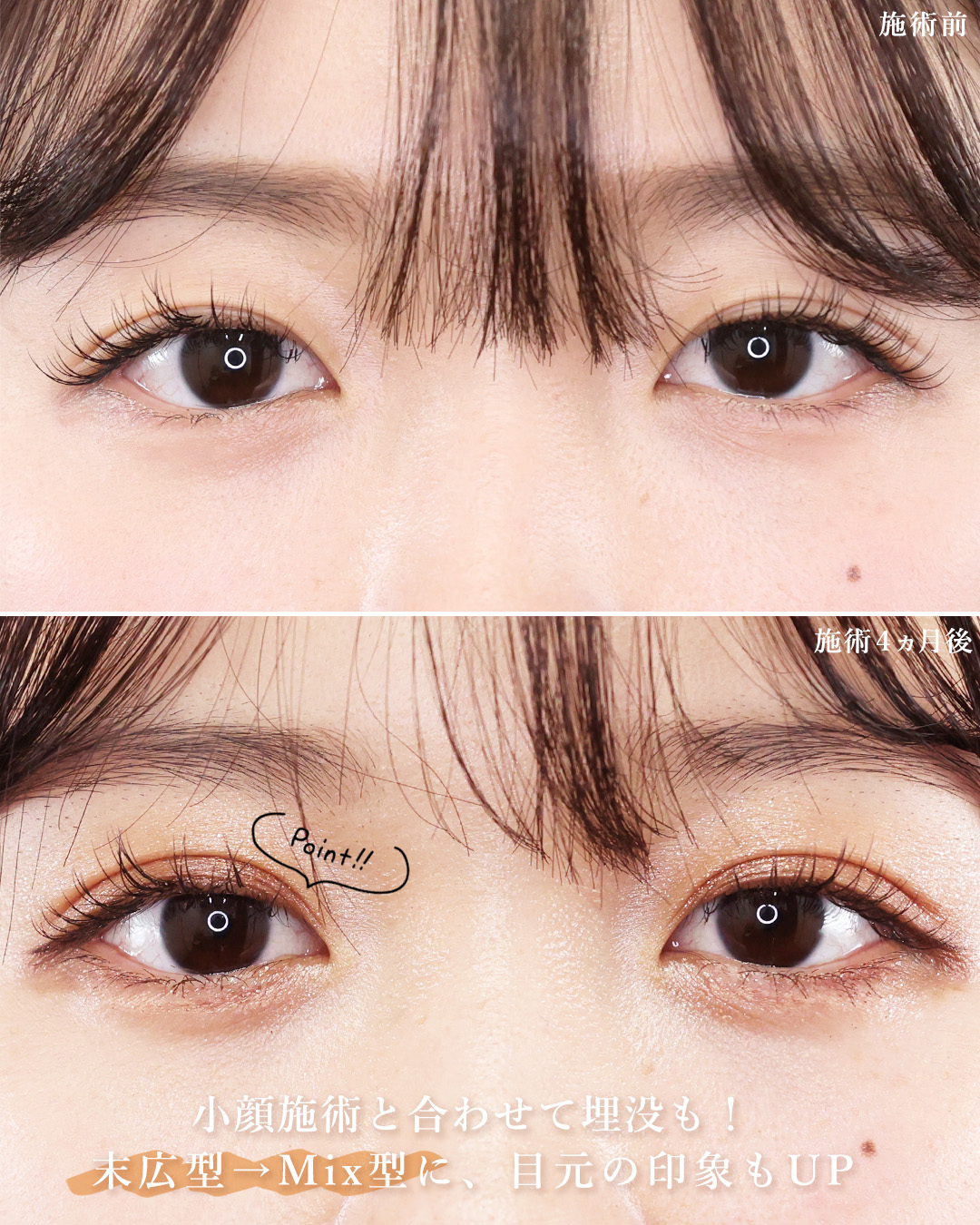 二重埋没法/TAC式 ツヤ肌コラーゲンリフト®/エラボトックス注射の症例写真 施術前後 