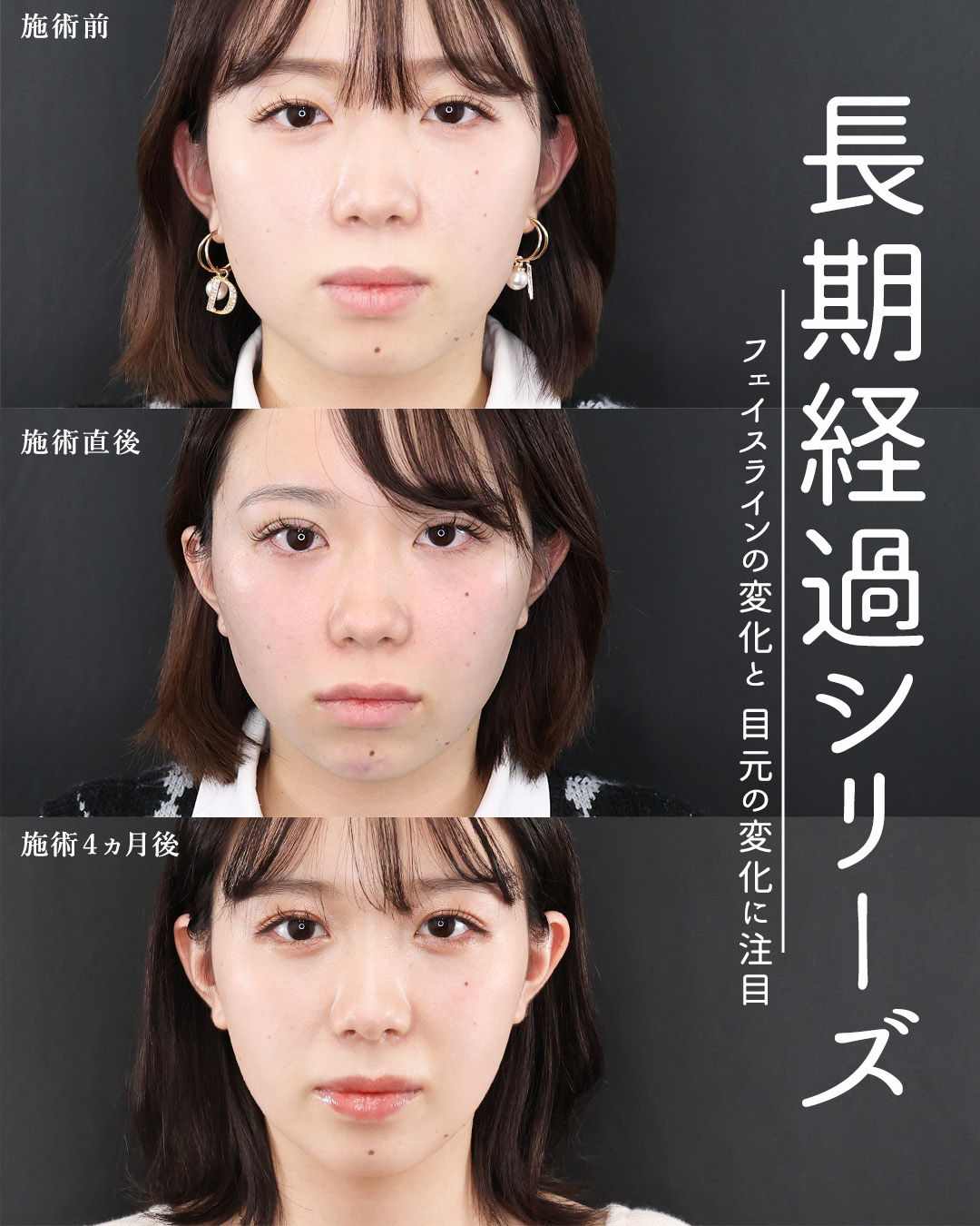 二重埋没法/TAC式 ツヤ肌コラーゲンリフト®/エラボトックス注射の症例写真 施術前後 