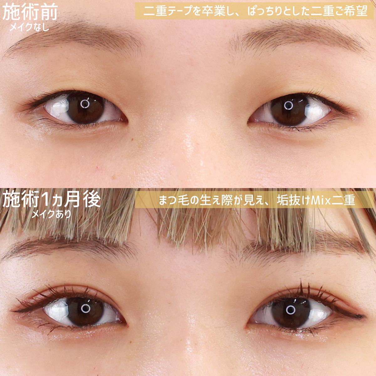 二重埋没法/目元：その他の症例写真 施術前後 