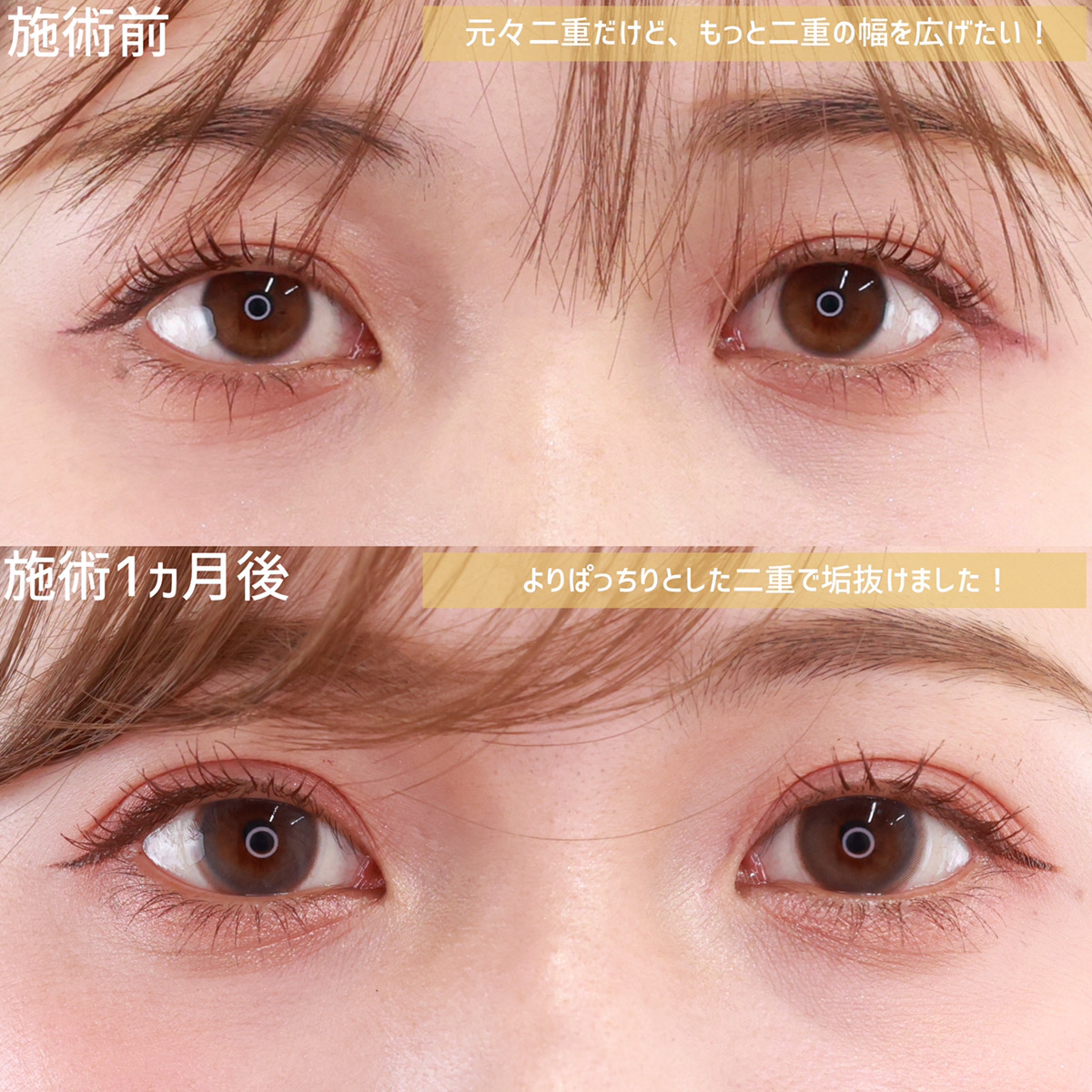 二重埋没法の症例写真 施術前後
