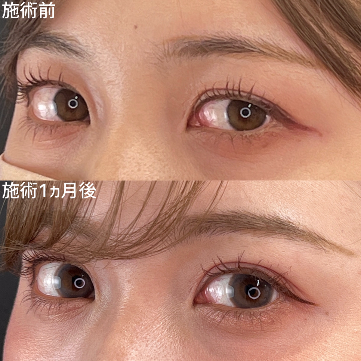 二重埋没法の症例写真 施術前後