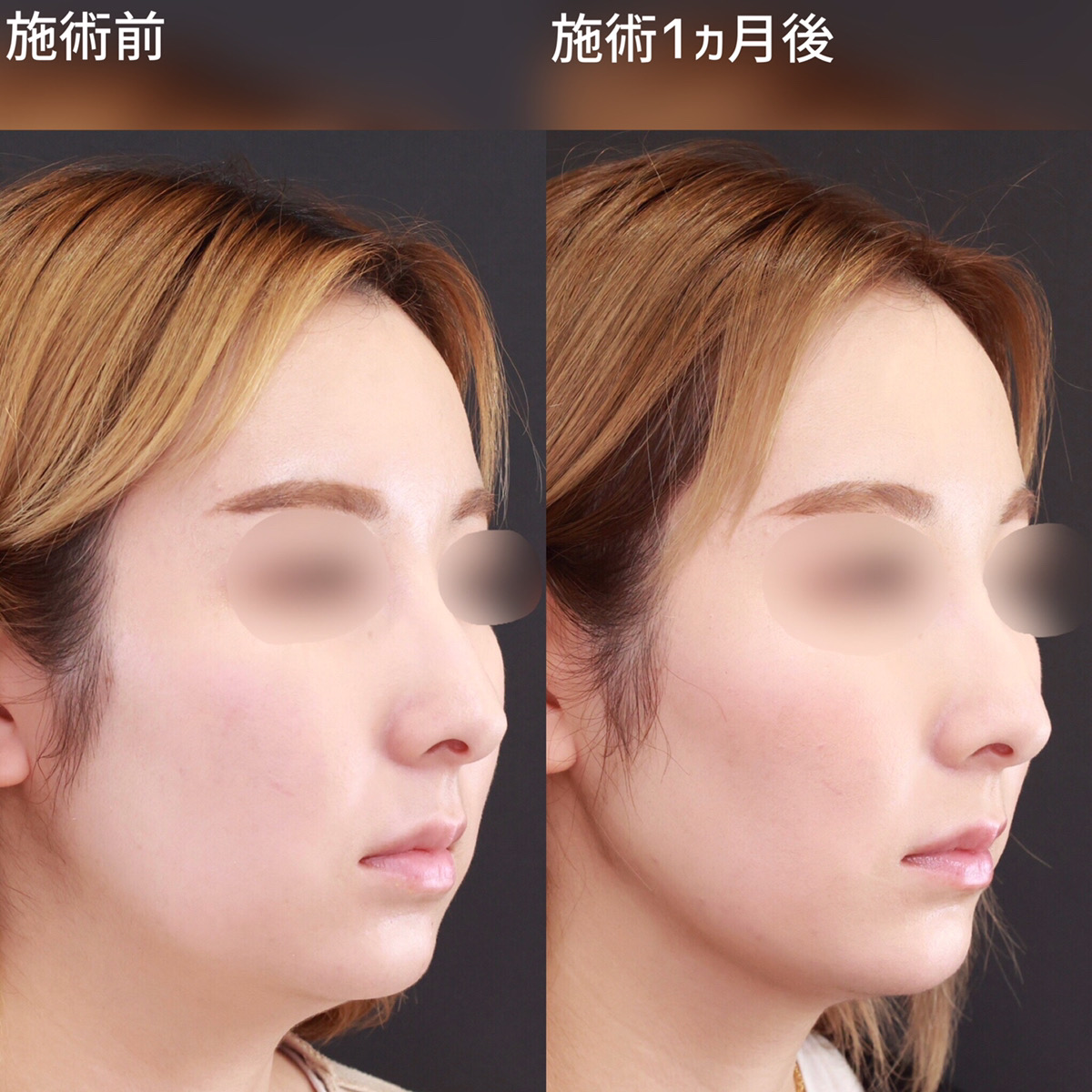 ぼやけていたフェイスラインを改善し、美しい輪郭に導く