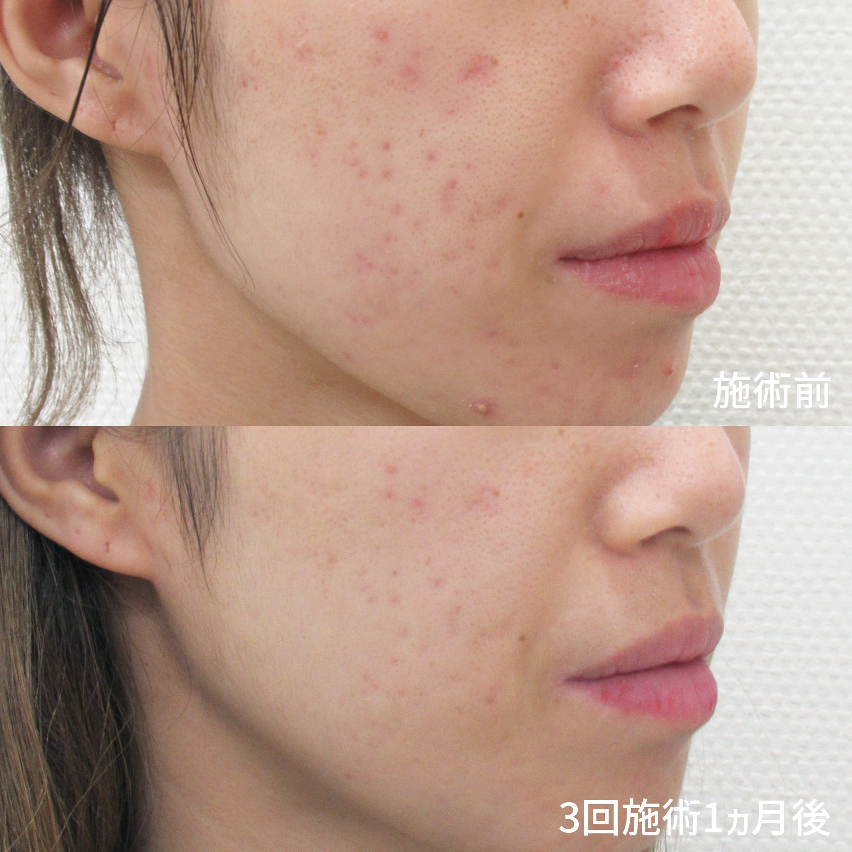 ダーマペン4/エクソソーム/ベルベットスキンの症例写真 施術前後 