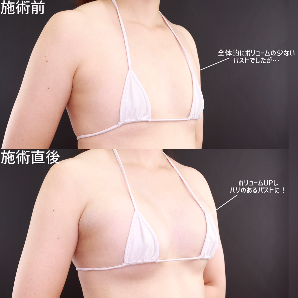 ヒアルロン酸注入豊胸術(グラビアバスト)の症例写真 施術前後