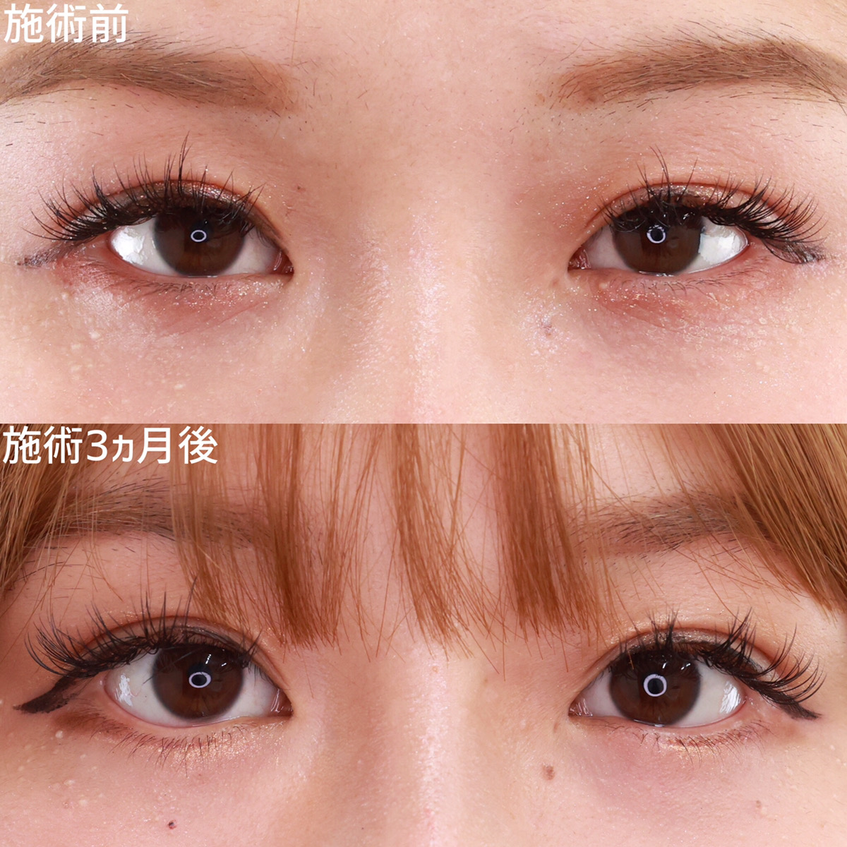 グラマラスライン(タレ目形成)の症例写真 施術前後