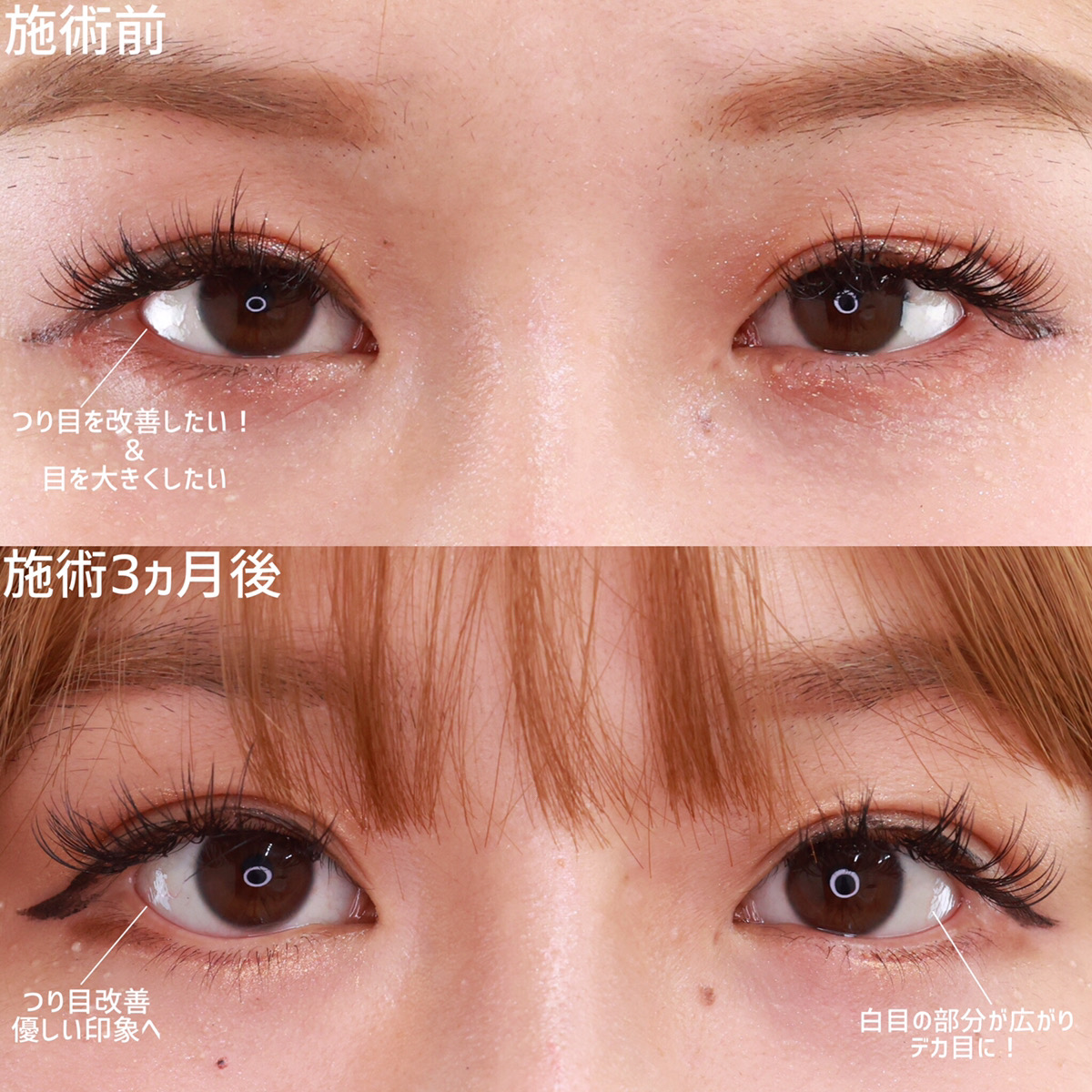 グラマラスライン(タレ目形成)の症例写真 施術前後