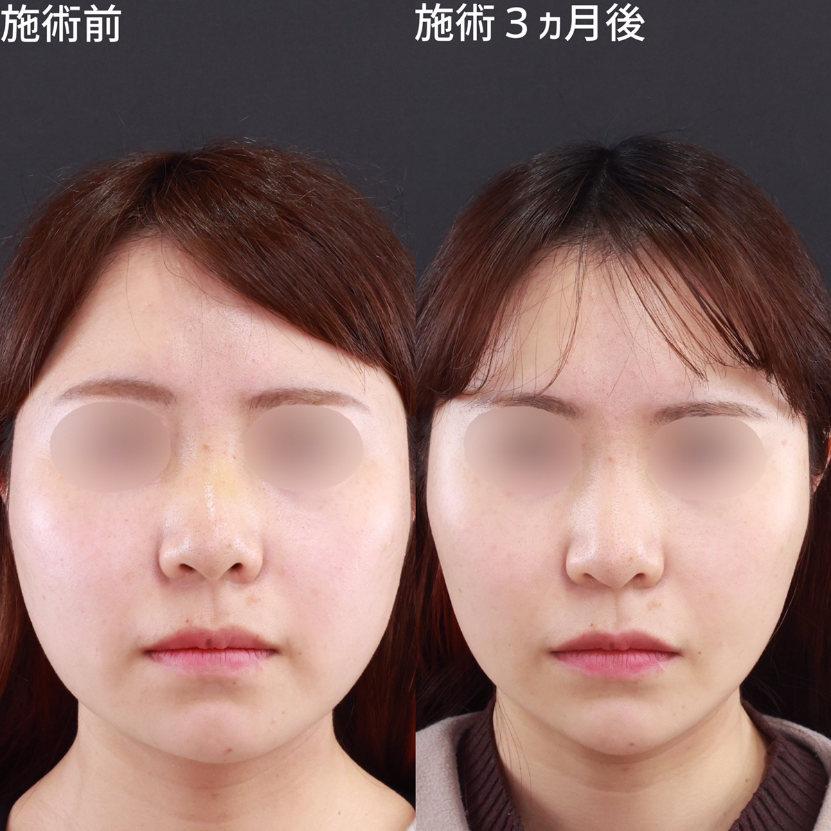 周りから小顔を褒められるようになったのは「パーフェクトフェイスライン」のおかげ！