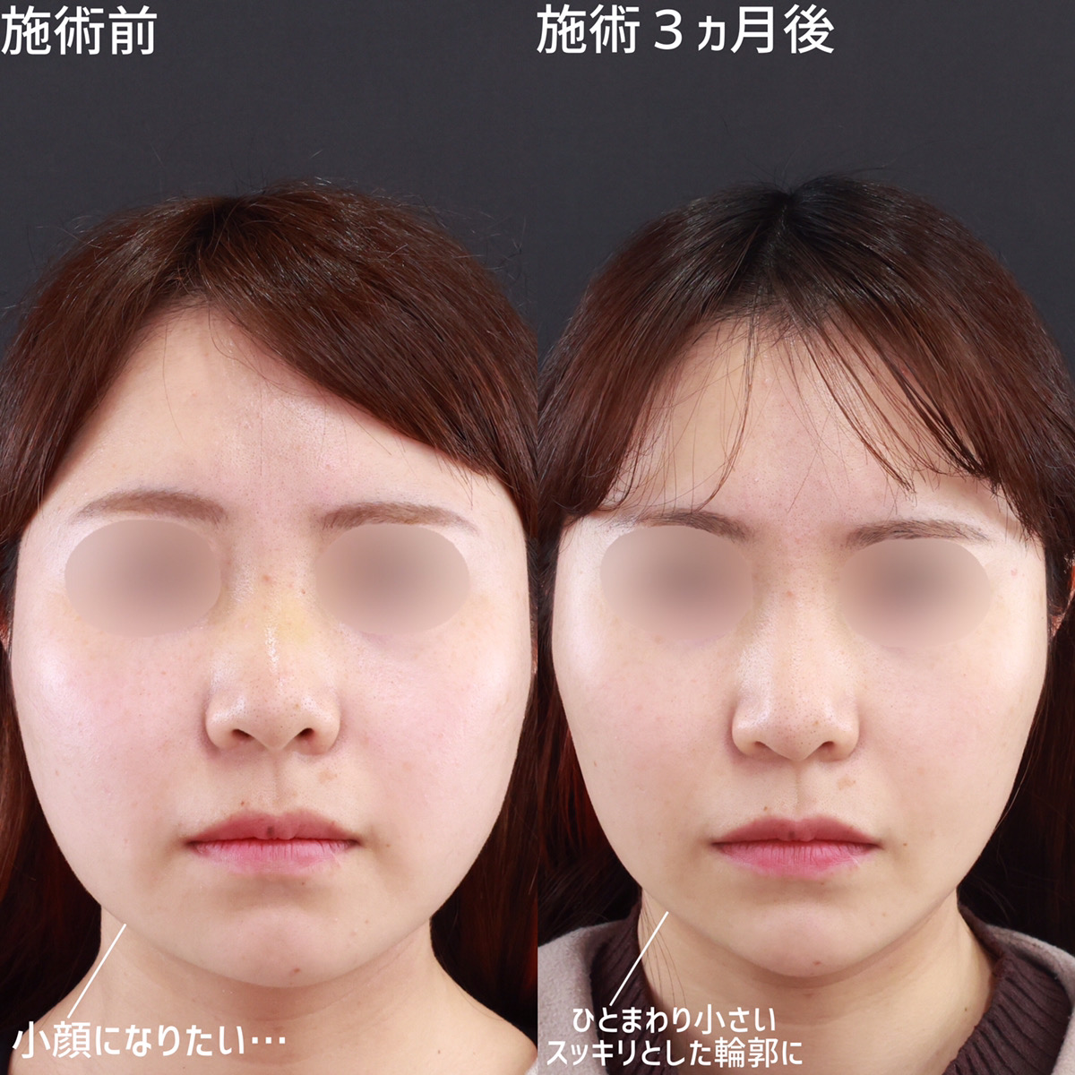 小顔整形｜パーフェクトフェイスライン/TAC式 ツヤ肌コラーゲンリフト®/ジョールファット除去の症例写真 施術前後 