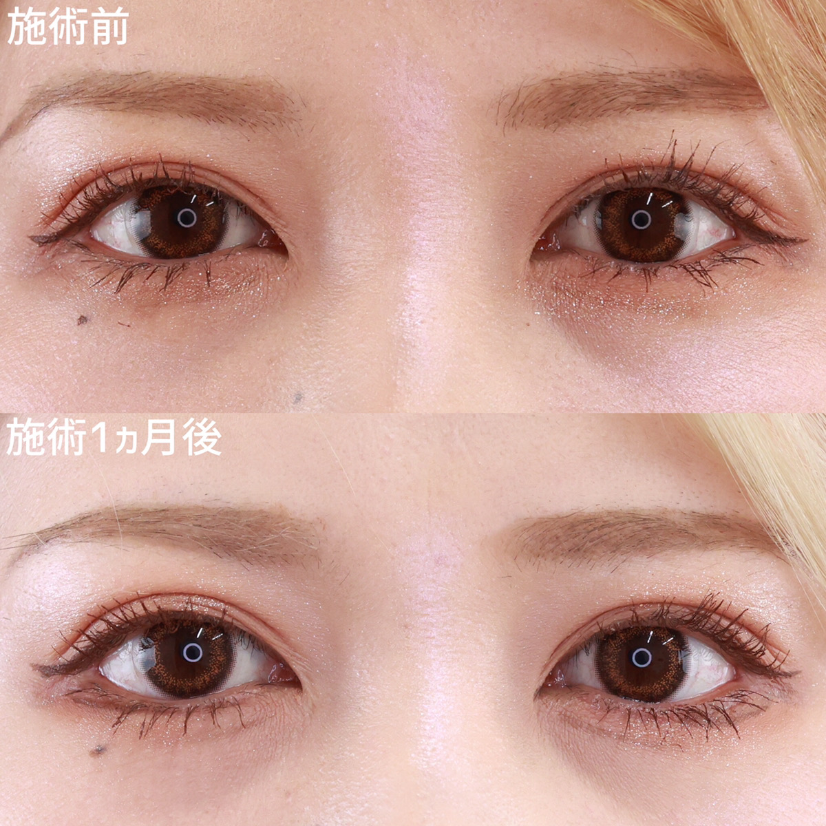 【グラマラスライン切開術】自然で優しい雰囲気に