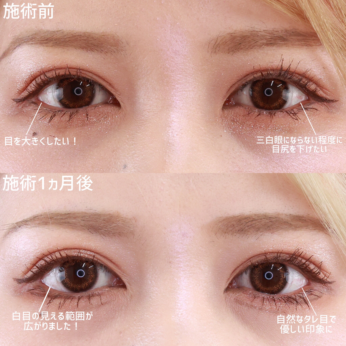 グラマラスライン（タレ目形成）の症例写真 施術前後 