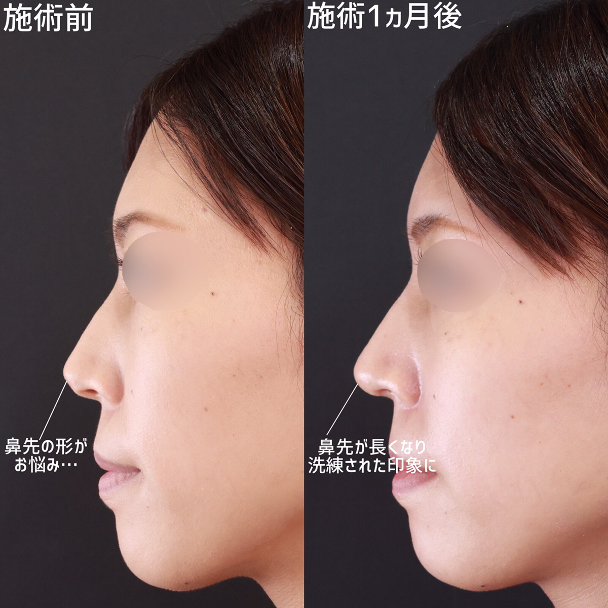 鼻尖形成・鼻尖縮小/鼻先軟骨移植の症例写真 施術前後 