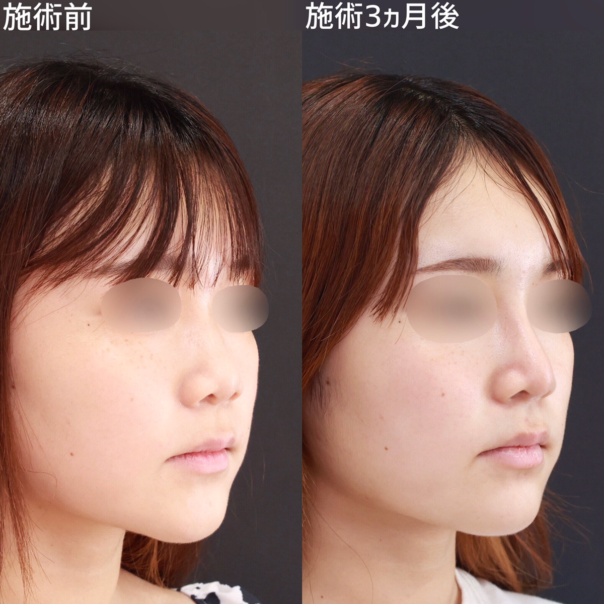 鼻尖形成/軟骨移植/プロテーゼの組み合わせで理想の鼻