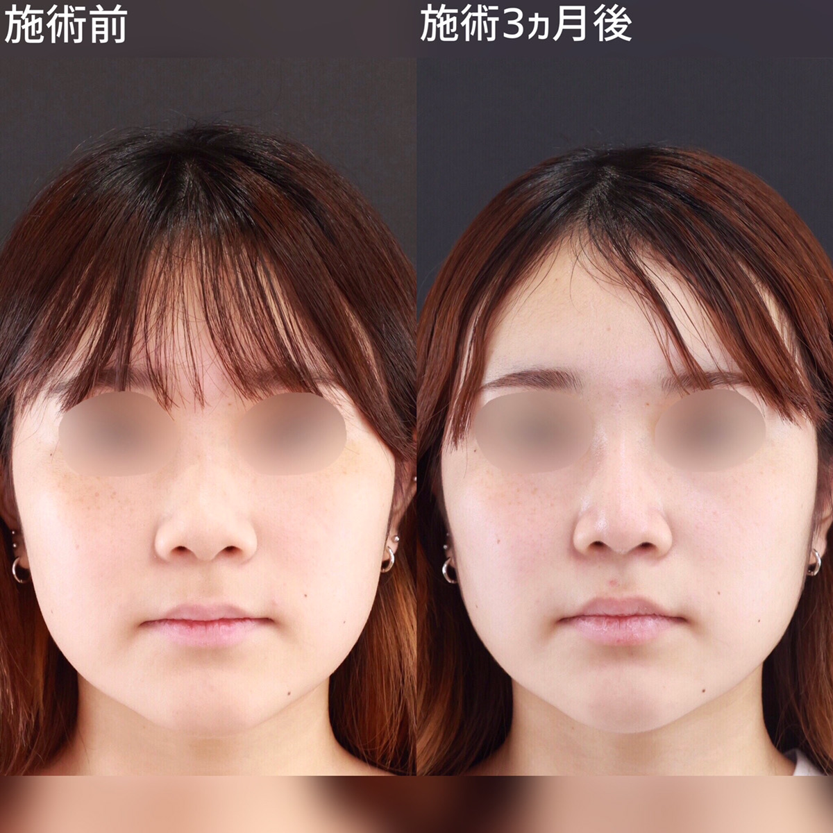 鼻尖形成・鼻尖縮小/鼻先軟骨移植/隆鼻術（プロテーゼ・自家組織）の症例写真 施術前後 
