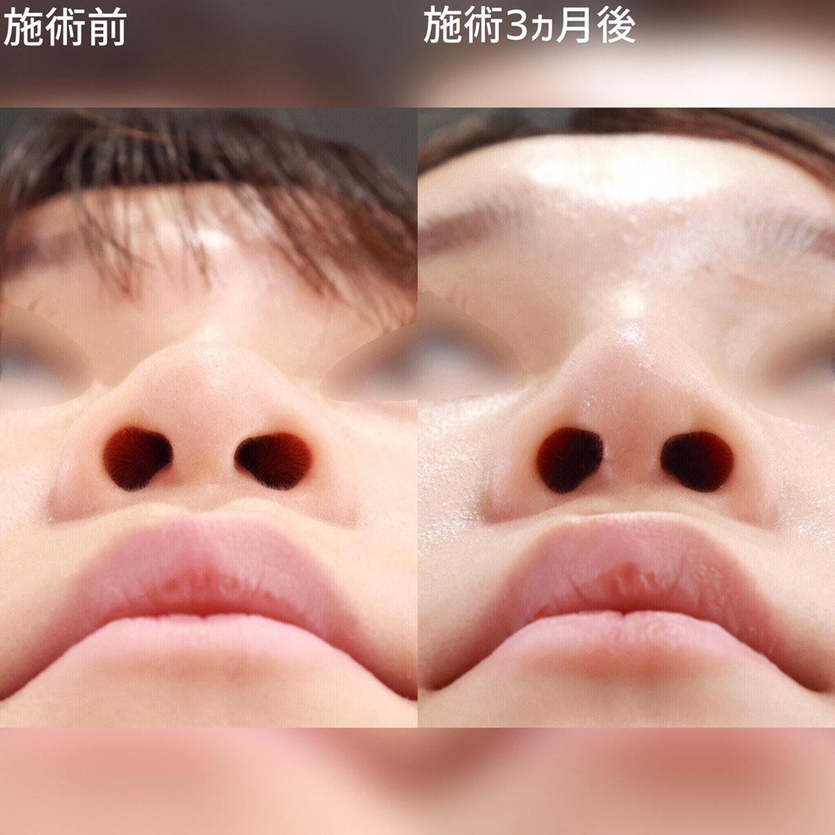 鼻尖形成・鼻尖縮小/鼻先軟骨移植/隆鼻術（プロテーゼ・自家組織）の症例写真 施術前後 