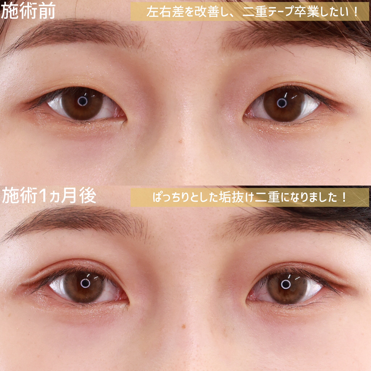 二重埋没法/目元：その他の症例写真 施術前後 