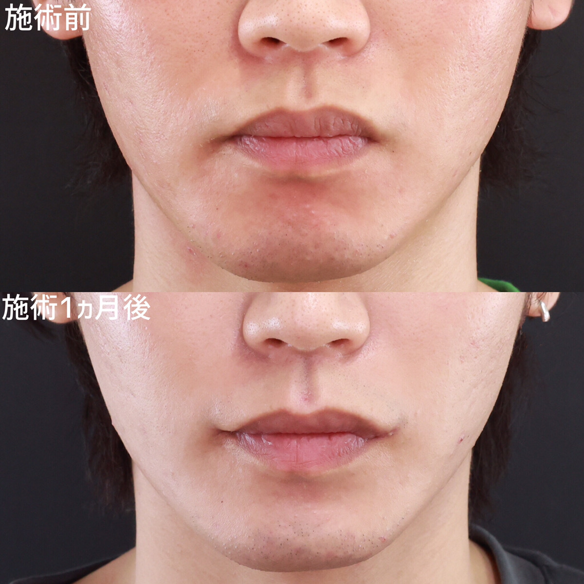 【口角挙上】明るく優しい口元で好印象！