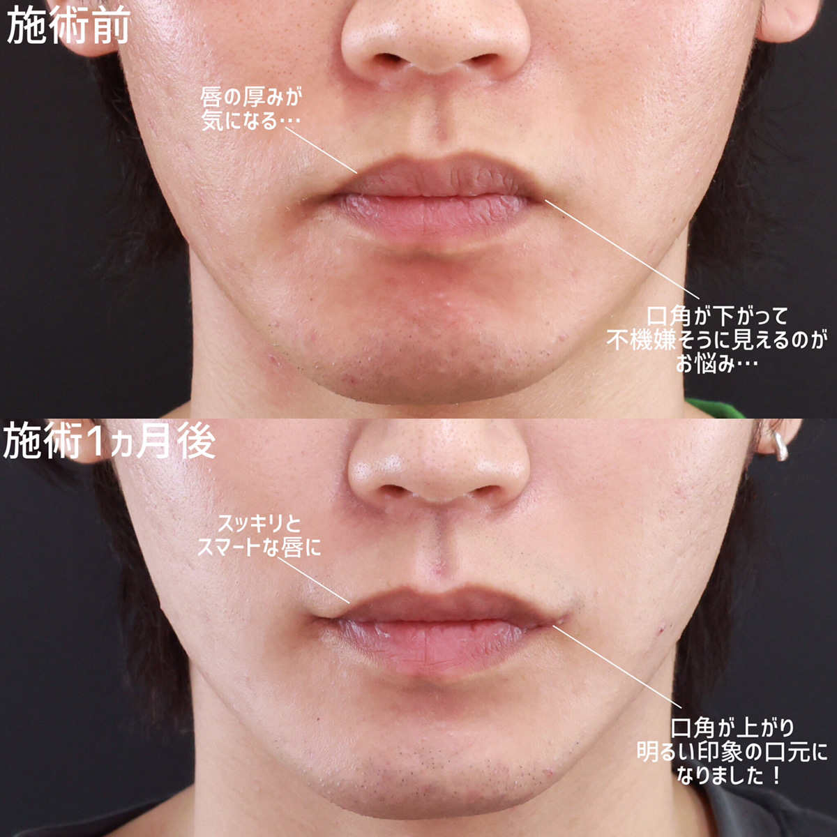 口角挙上・リフト（マイクロ切開法・内側法/口内法）/口唇縮小術の症例写真 施術前後 