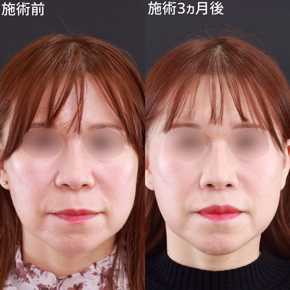 若々しい印象を与える秘訣は【人中短縮術】