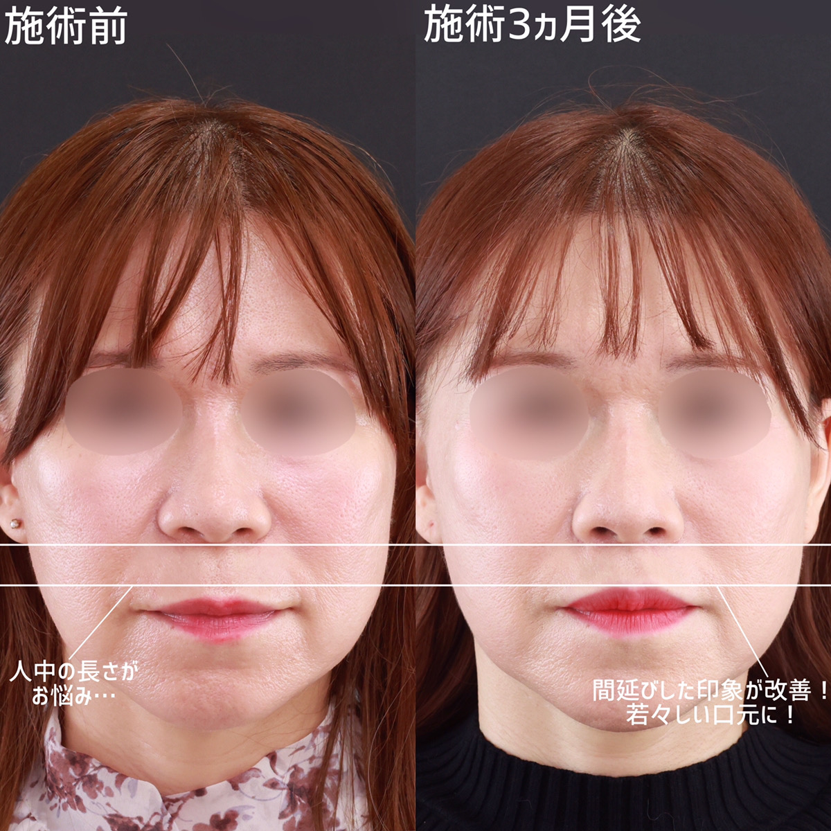 人中短縮術(リップリフト)・外側人中短縮術の症例写真 施術前後 