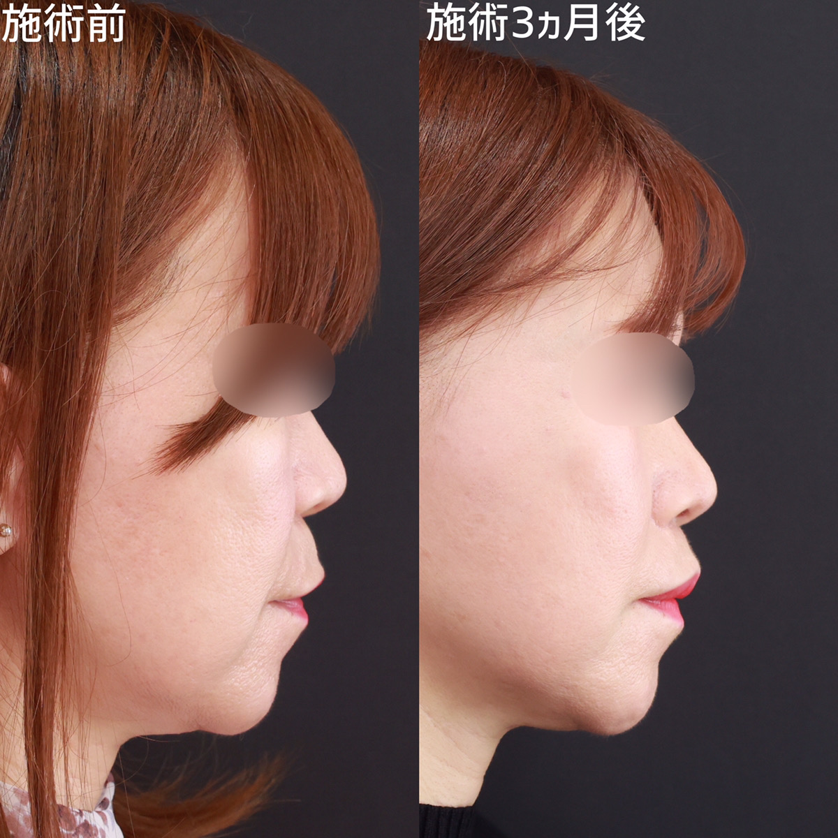 人中短縮術(リップリフト)・外側人中短縮術の症例写真 施術前後 