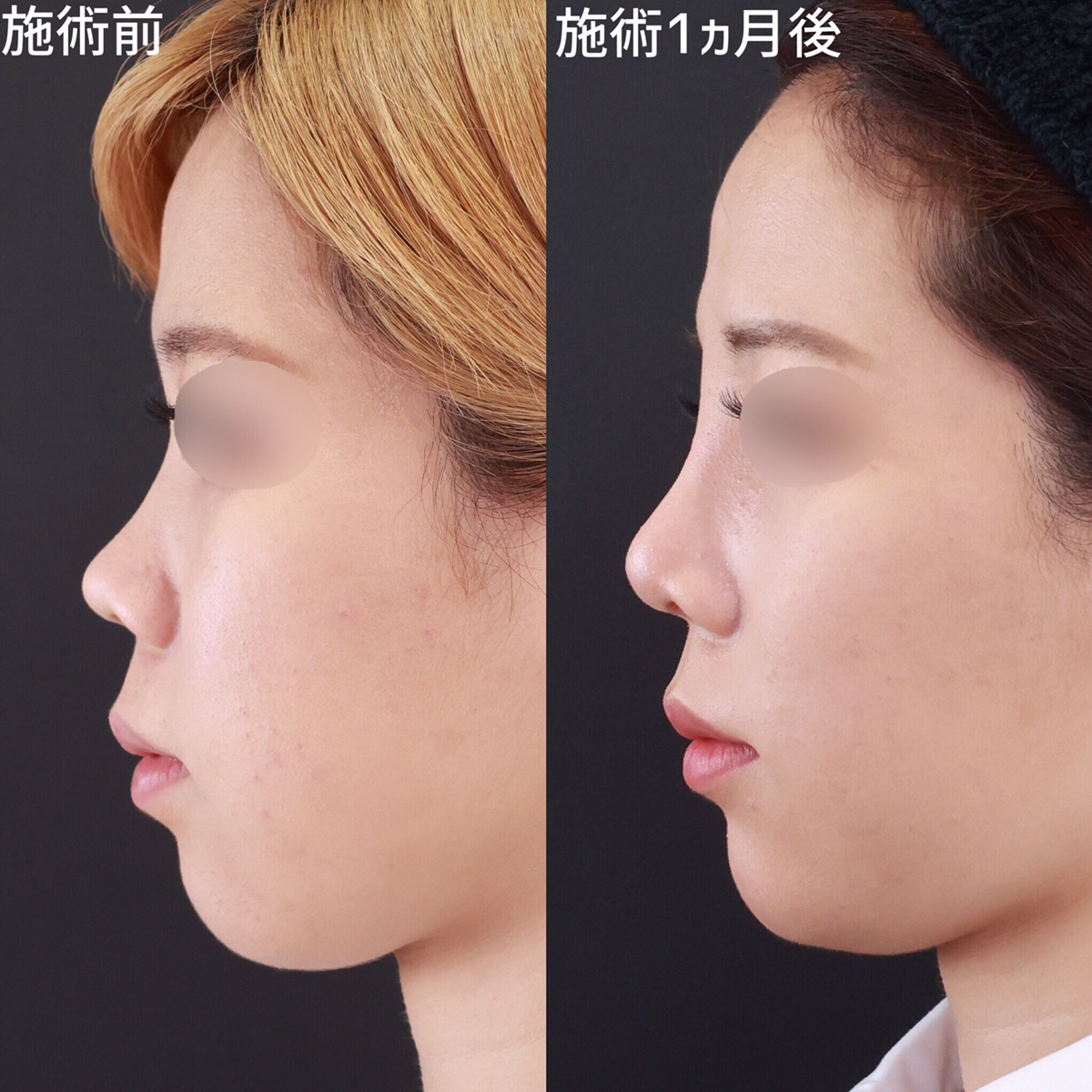 鼻の複合施術で幼い印象から大人の雰囲気へ
