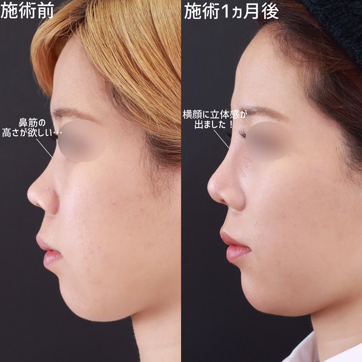 隆鼻術（プロテーゼ・自家組織）/鼻尖形成・鼻尖縮小/鼻先軟骨移植の症例写真 施術前後 