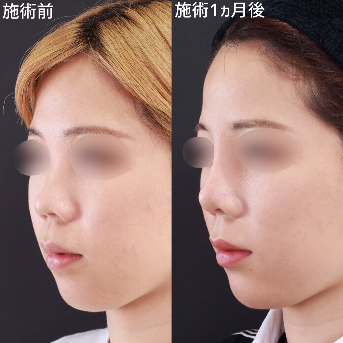 隆鼻術（プロテーゼ・自家組織）/鼻尖形成・鼻尖縮小/鼻先軟骨移植の症例写真 施術前後 