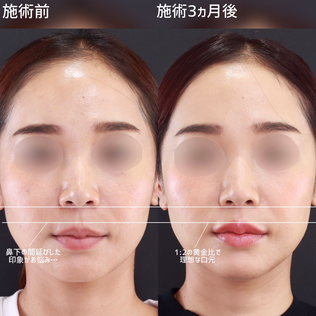 人中短縮術(リップリフト)・外側人中短縮術の症例写真 施術前後 