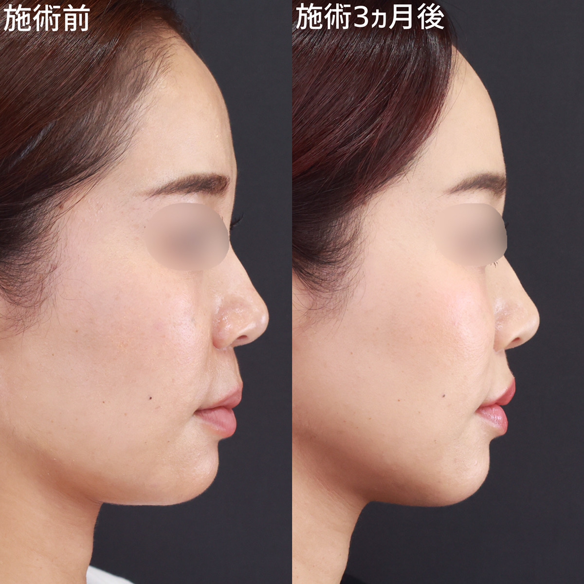 人中短縮術(リップリフト)・外側人中短縮術の症例写真 施術前後 