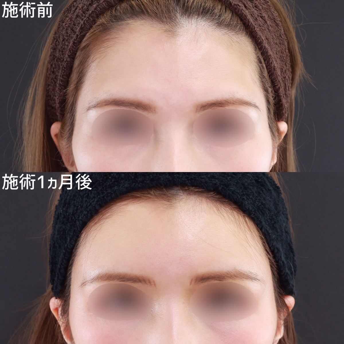 額とこめかみに丸みが出て健康的な印象に【コンデンスリッチフェイス】