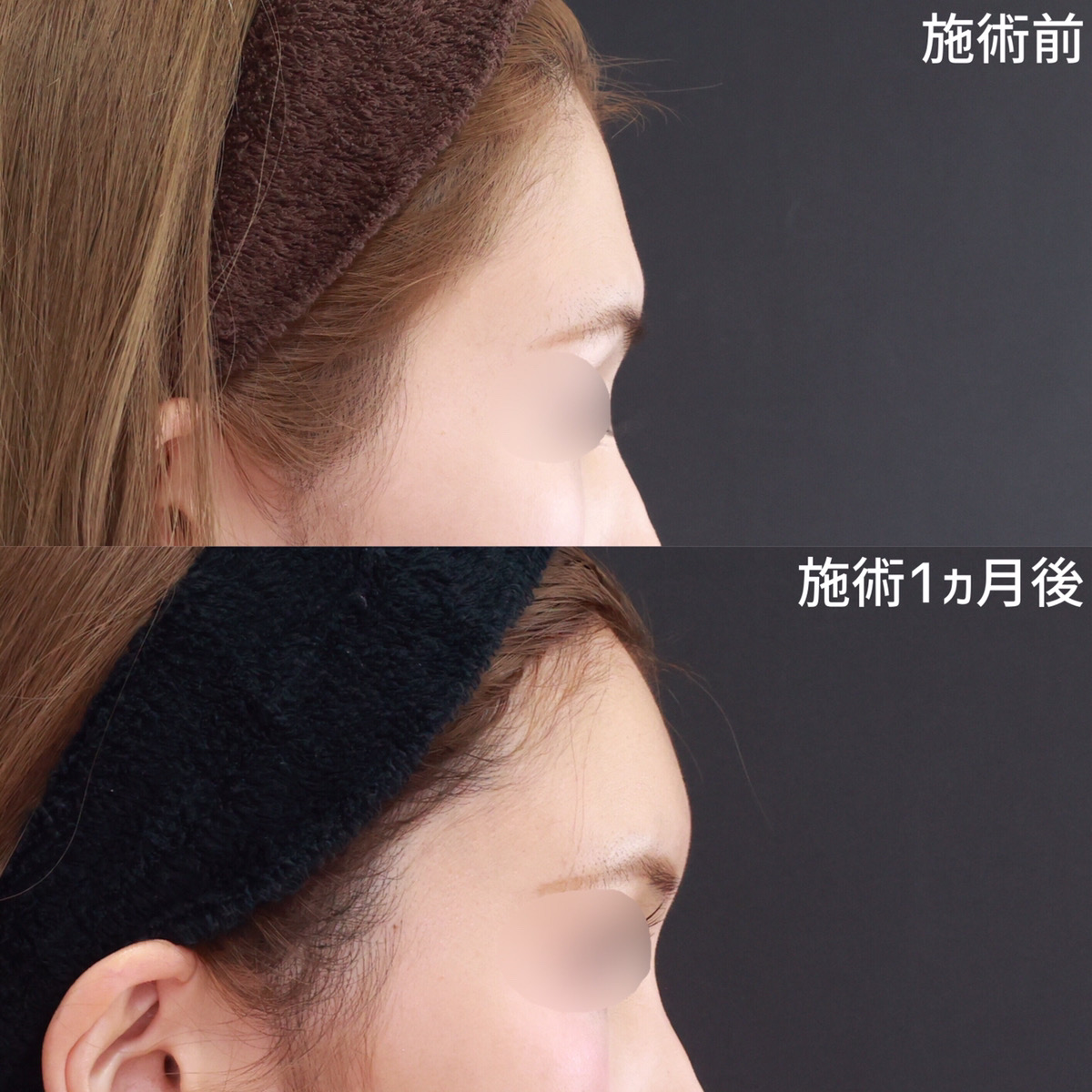 おでこの脂肪注入（オルチャンデコ形成）の症例写真 施術前後 