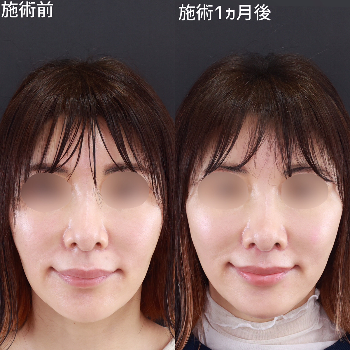 数ミリの違いで若々しい印象を与える【人中短縮術】