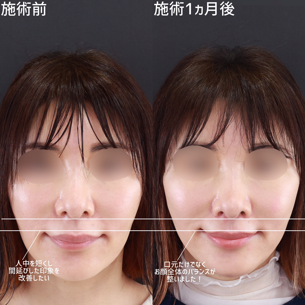 人中短縮術(リップリフト)・外側人中短縮術の症例写真 施術前後 