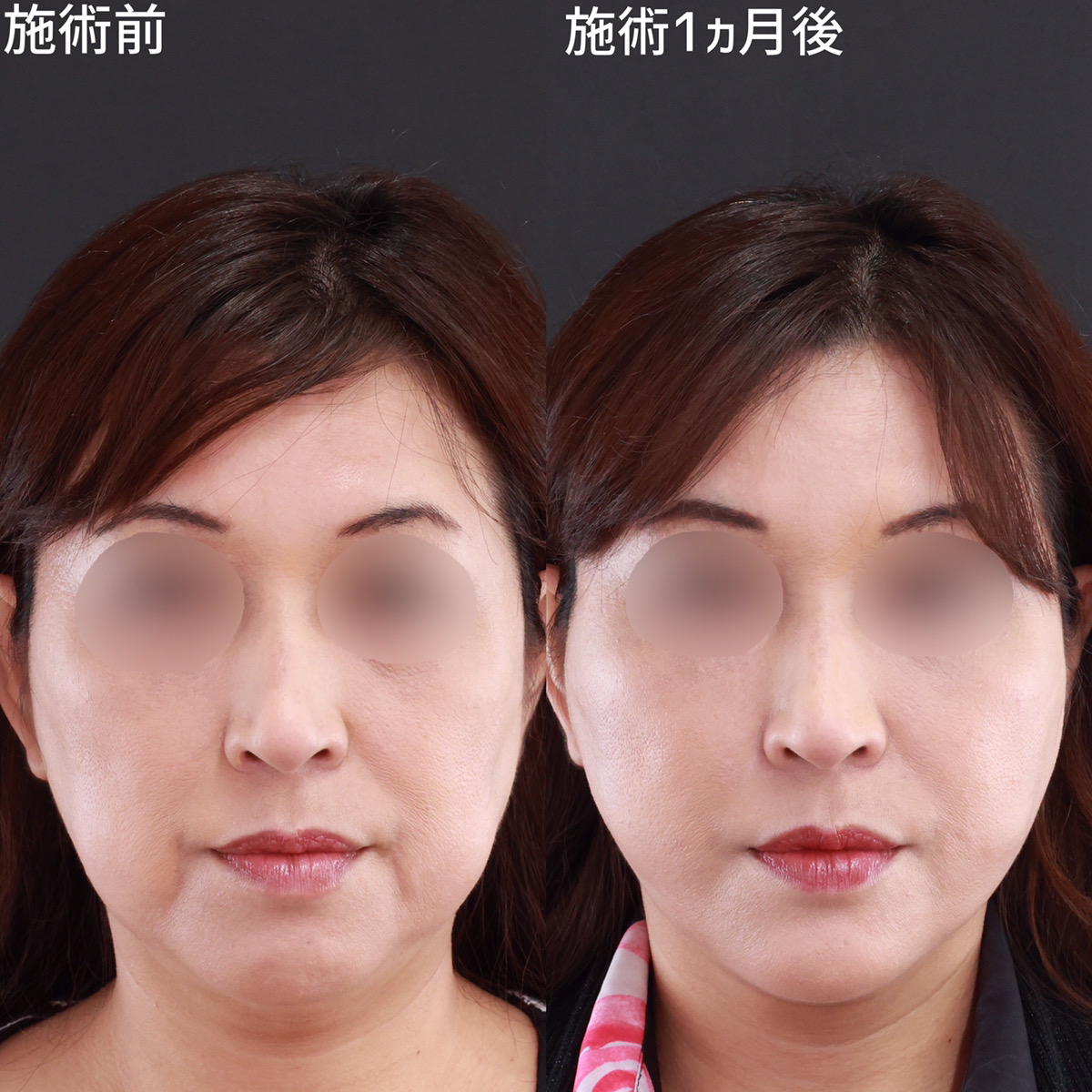 糸リフト×脂肪除去の相乗効果で口周りのもたつき改善！若々しい卵型の輪郭に