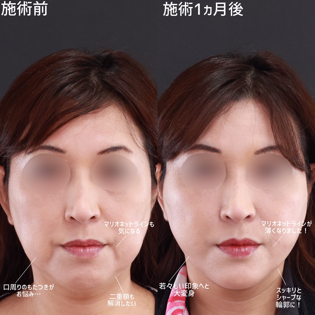 小顔整形｜パーフェクトフェイスライン/ジョールファット除去/顎下の脂肪吸引・顔の脂肪吸引の症例写真 施術前後 