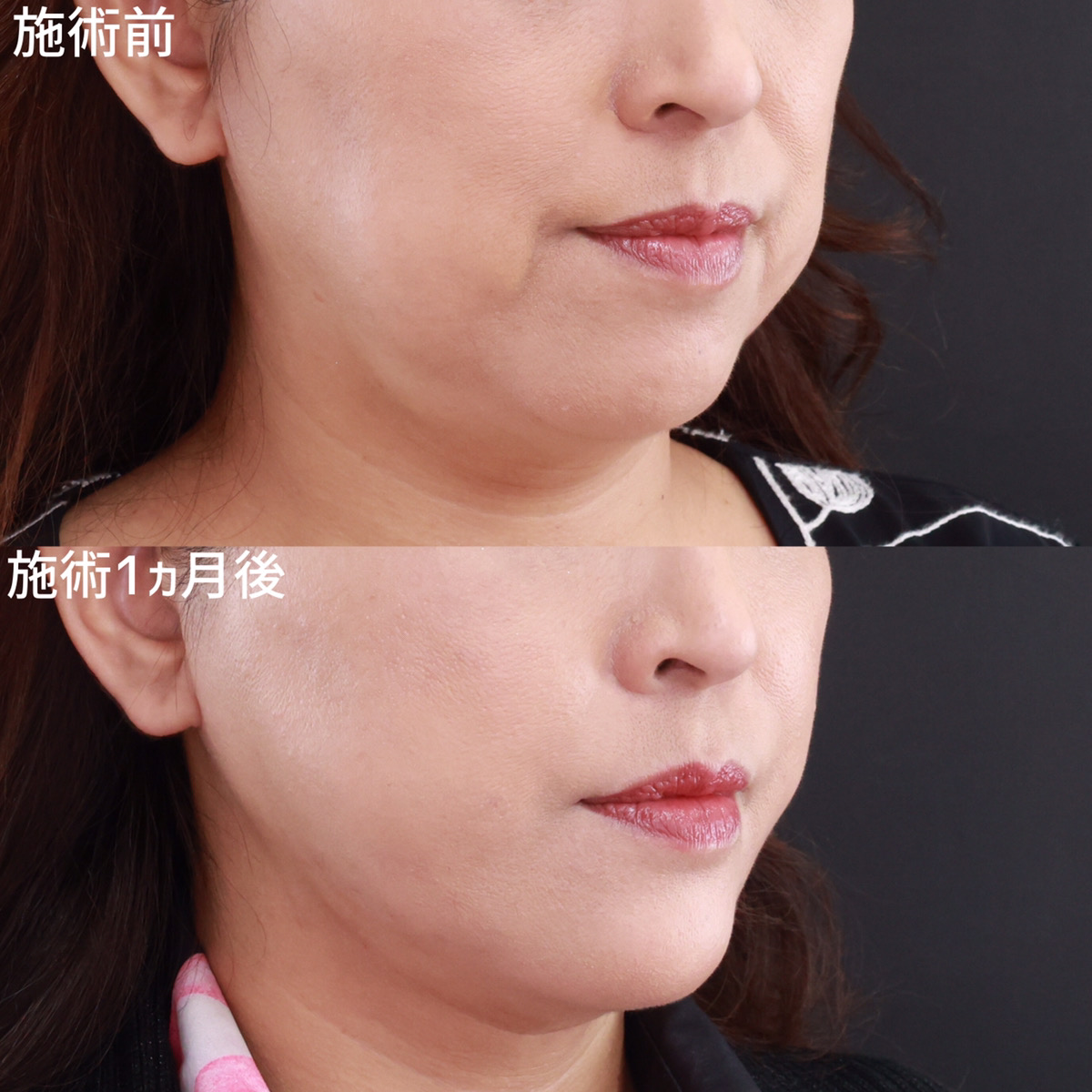 小顔整形｜パーフェクトフェイスライン/ジョールファット除去/顎下の脂肪吸引・顔の脂肪吸引の症例写真 施術前後 
