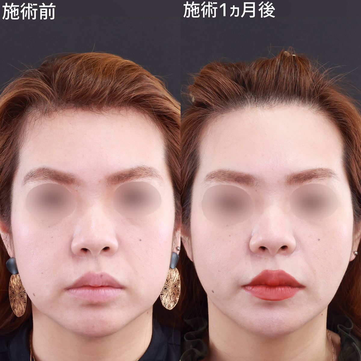 口周りのもたつきは【糸リフト×脂肪除去】で解決！【福岡TAクリック】