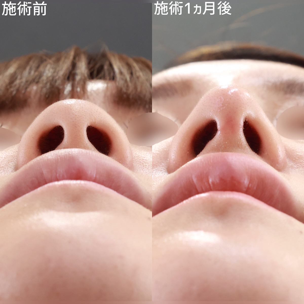 鼻尖形成・鼻尖縮小/鼻中隔延長術/鼻先軟骨移植の症例写真 施術前後 