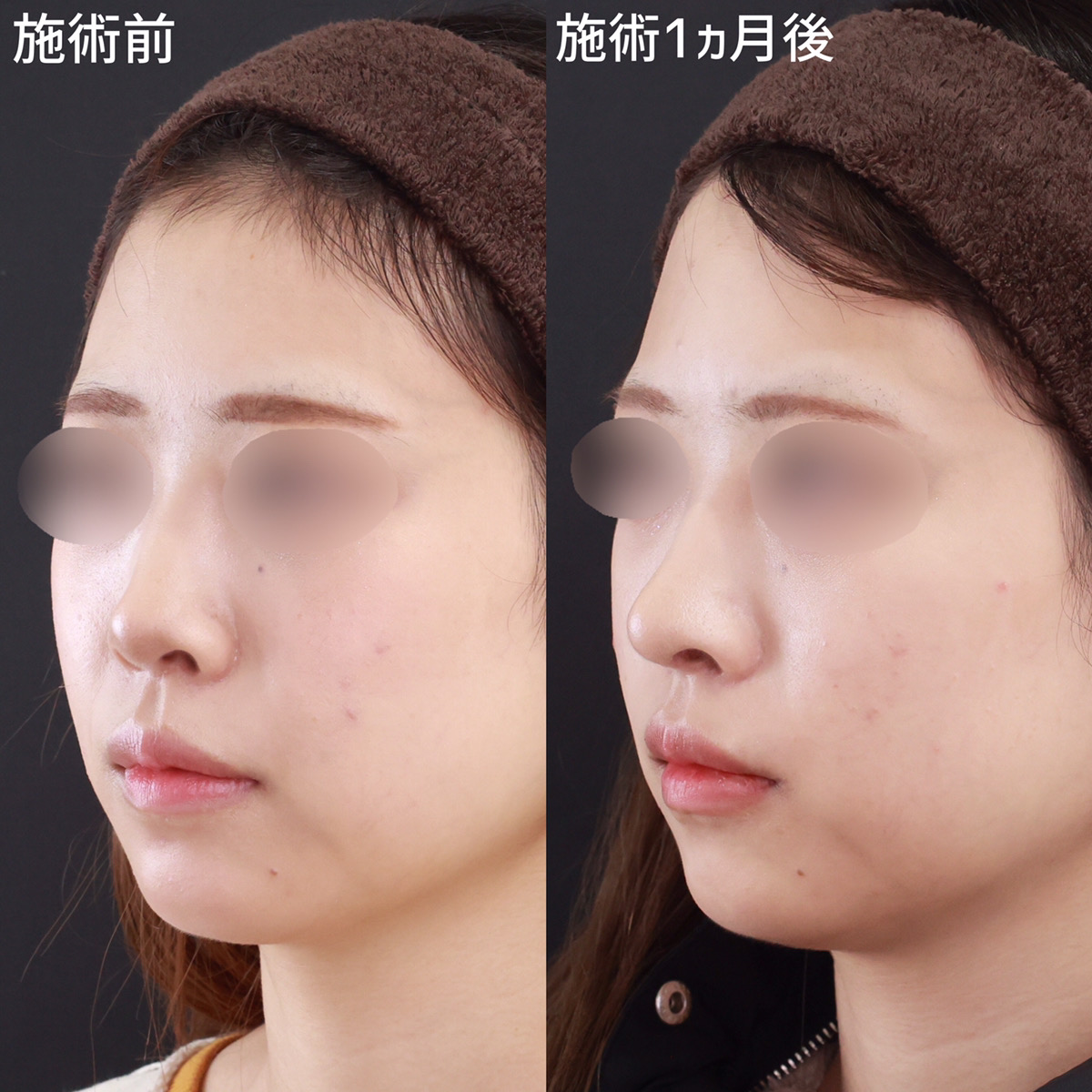 鼻尖形成・鼻尖縮小/鼻先軟骨移植/TAC式 鼻翼縮小術（小鼻縮小）の症例写真 施術前後 