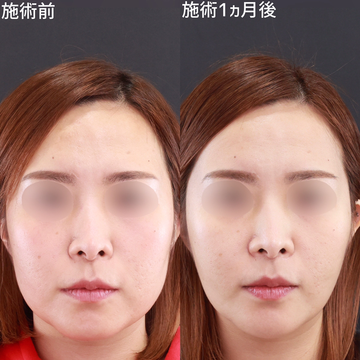 【パーフェクトフェイスライン】自分に合った施術で小顔に！