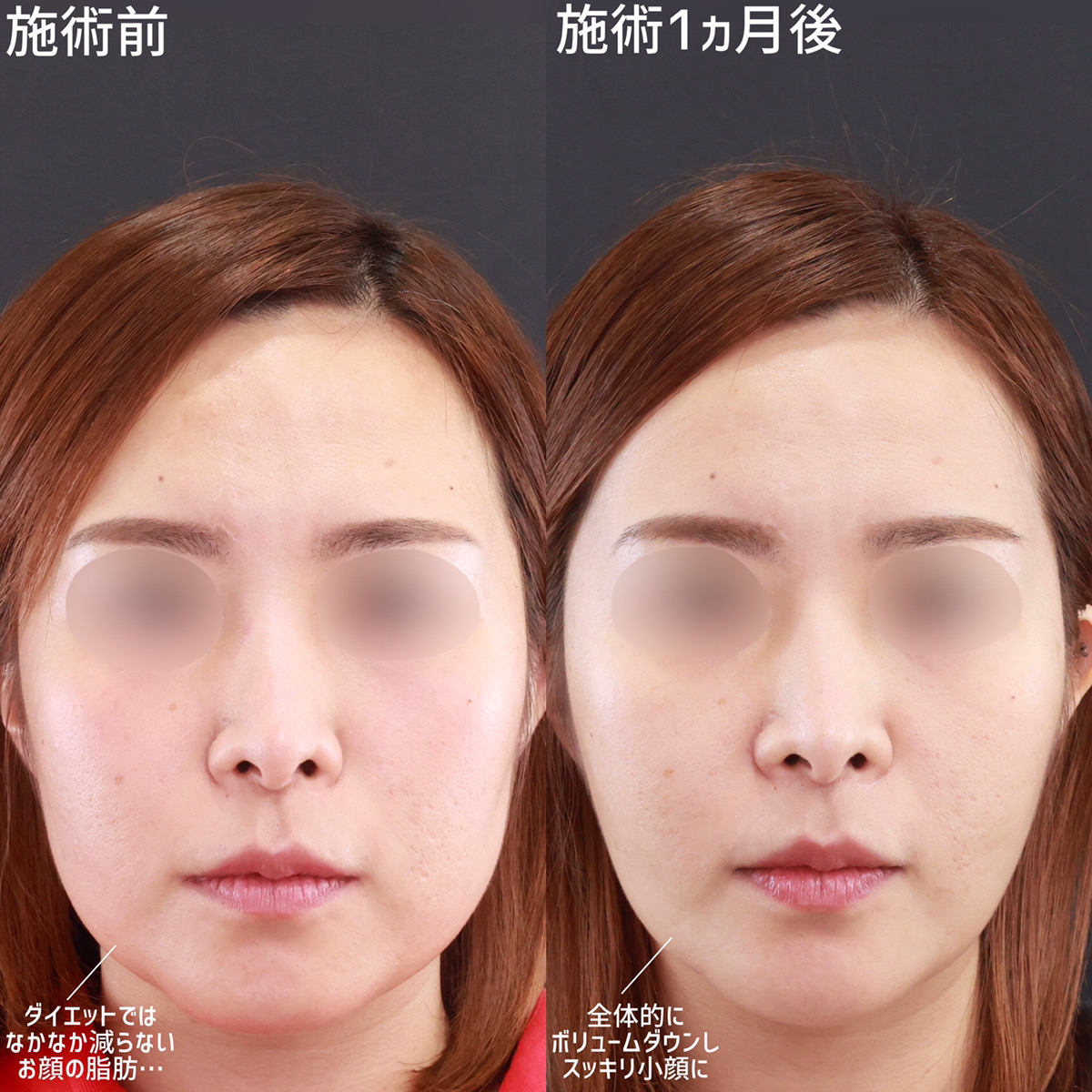 小顔整形｜パーフェクトフェイスライン/TAC式 ツヤ肌コラーゲンリフト®/顎下の脂肪吸引の症例写真 施術前後 