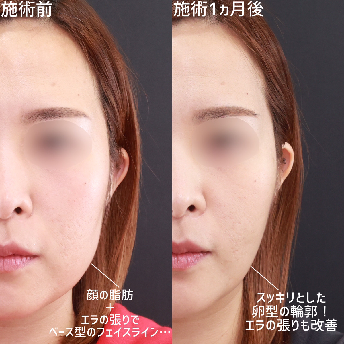 小顔整形｜パーフェクトフェイスライン/TAC式 ツヤ肌コラーゲンリフト®/顎下の脂肪吸引の症例写真 施術前後 