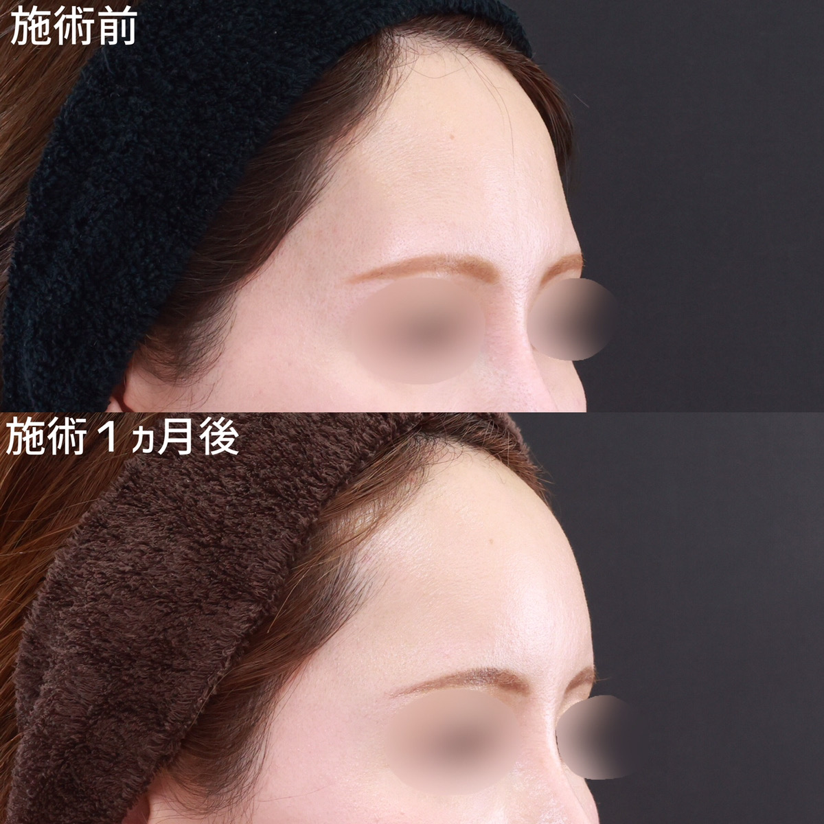 【コンデンスリッチフェイス】脂肪注入で丸みだけでなく、ハリ感もUP↑