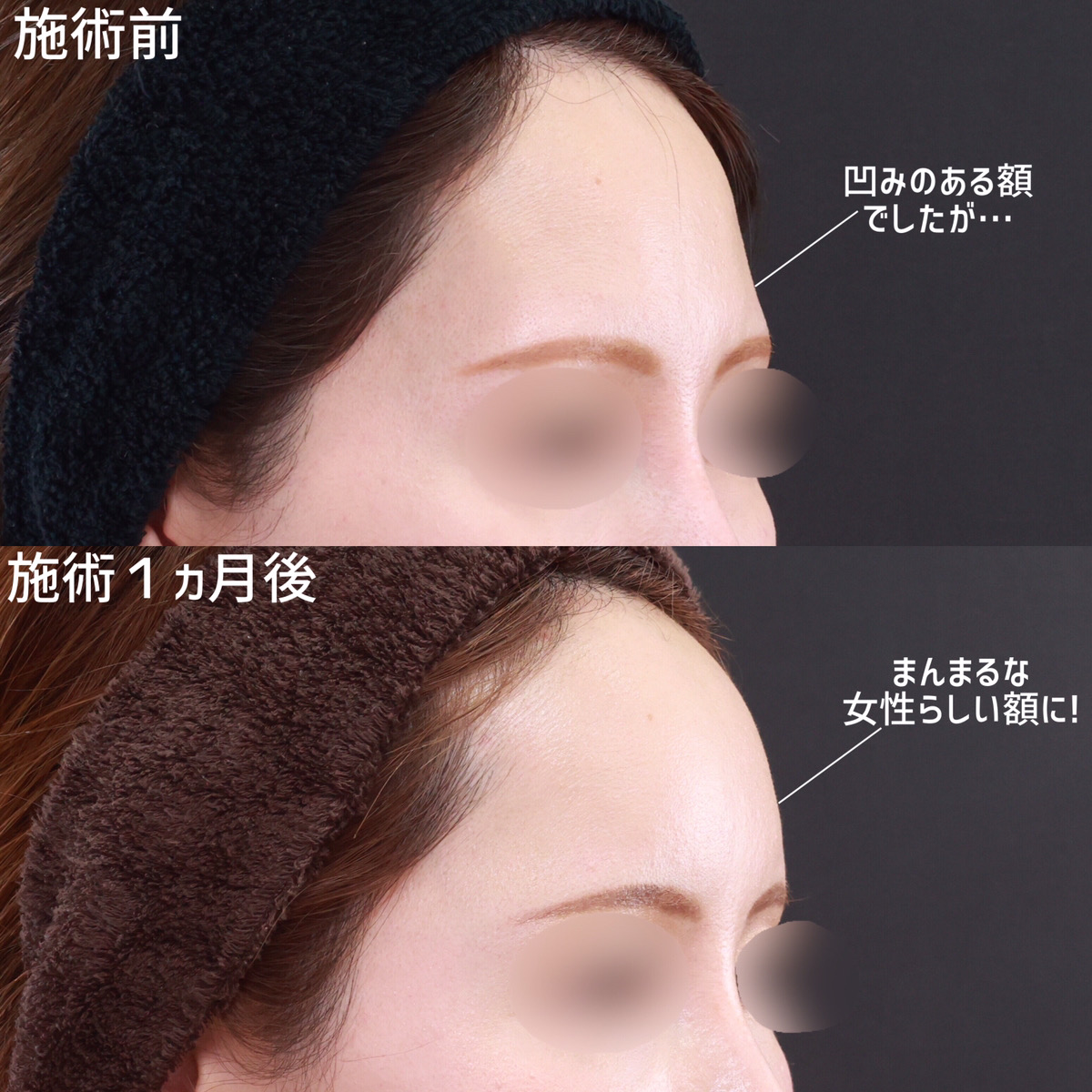 おでこの脂肪注入（オルチャンデコ形成）の症例写真 施術前後 