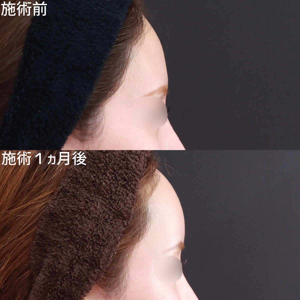 おでこの脂肪注入（オルチャンデコ形成）の症例写真 施術前後 