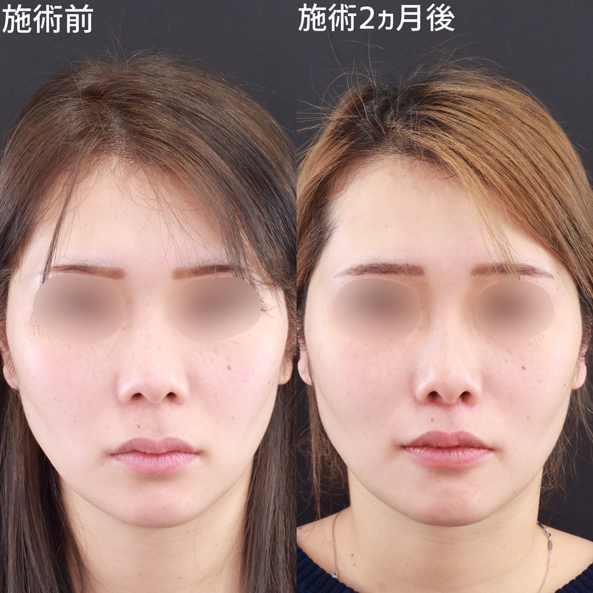 人中短縮術(リップリフト)・外側人中短縮術の症例写真 施術前後 