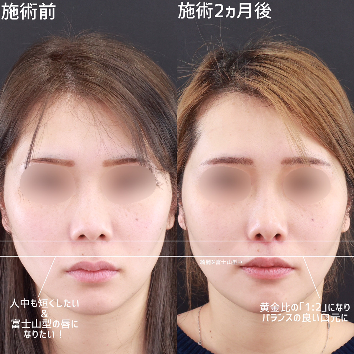 人中短縮術(リップリフト)・外側人中短縮術の症例写真 施術前後 