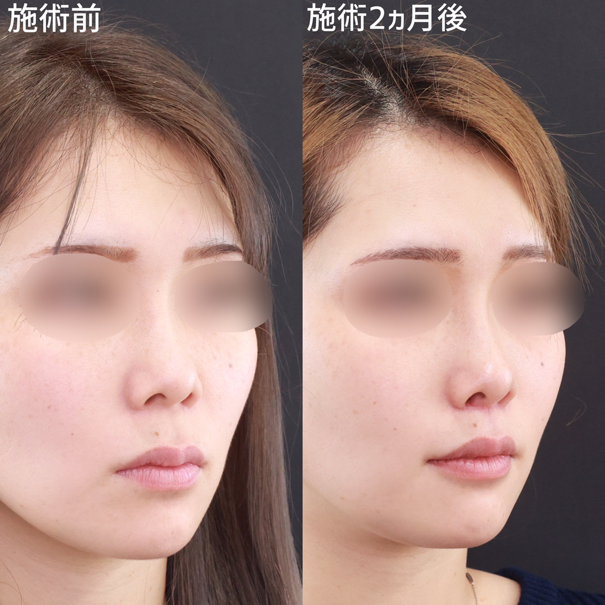 人中短縮術(リップリフト)・外側人中短縮術の症例写真 施術前後 